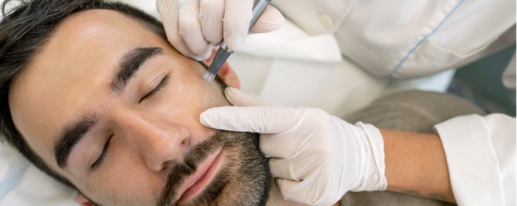 Key Benefits of Microneedling in Miami You Should Know